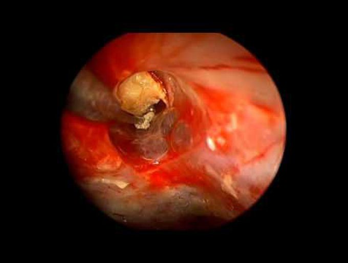An endoscopic assisted retrosigmoid approach to the cerebello-pontine angle for resection