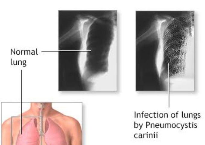 Pneumocystis pneumonia.