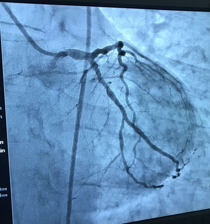 Left coronary artery