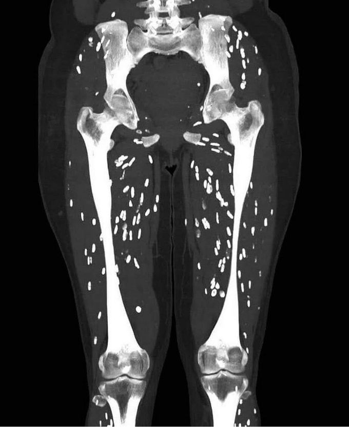 CT scan of a patient with cysticercosis