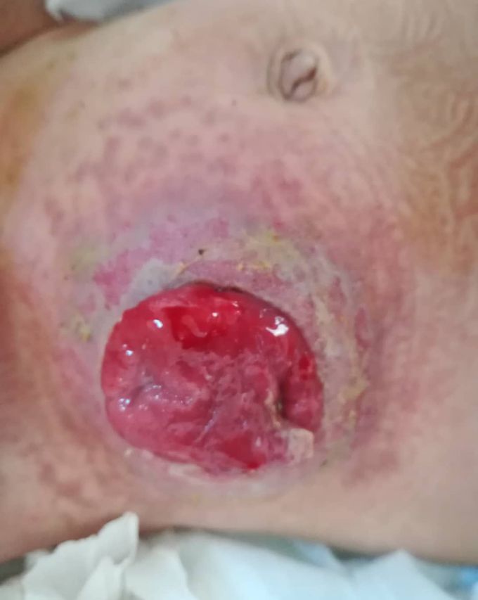 Colostomy in a 6 months old male patient to prepare patient for surgical treatment of Hirschsprung's disease. 