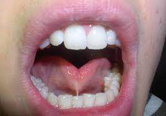 Treatment of ankyloglossia