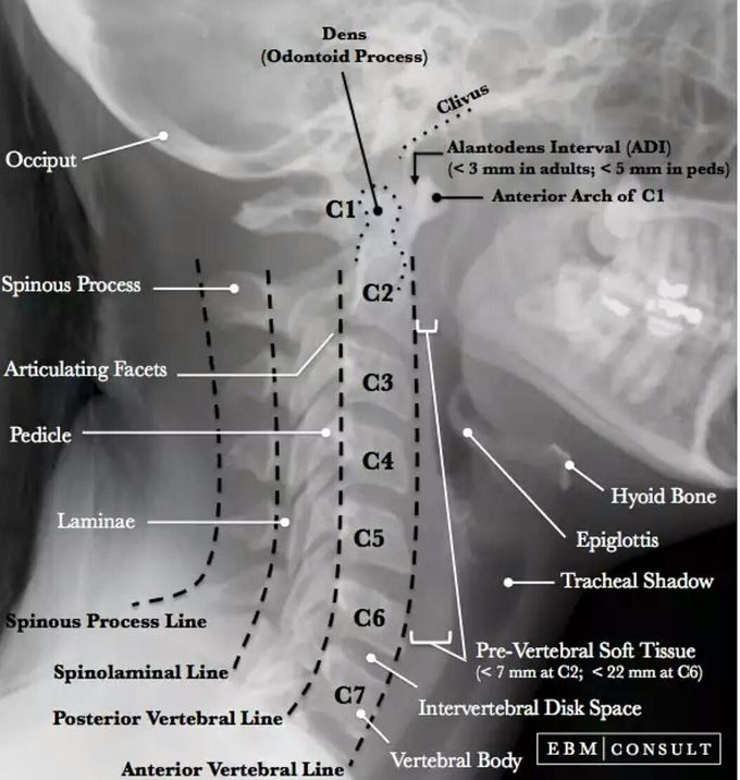Lateral Cervical Spine X-Ray