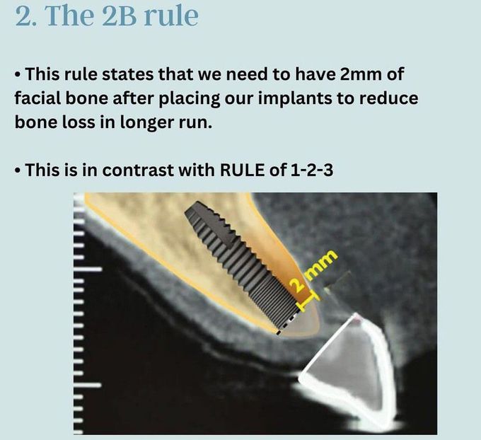 How to Choose the Correct Implant II