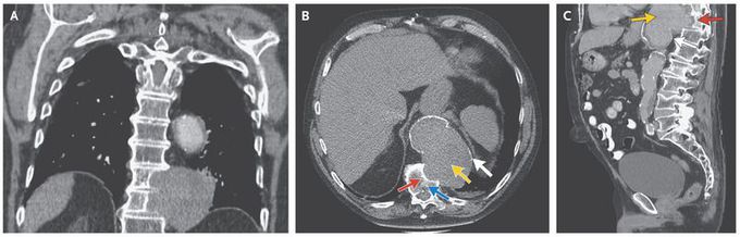 Vertebral-Body Erosion in Thoracic Aortic Aneurysm