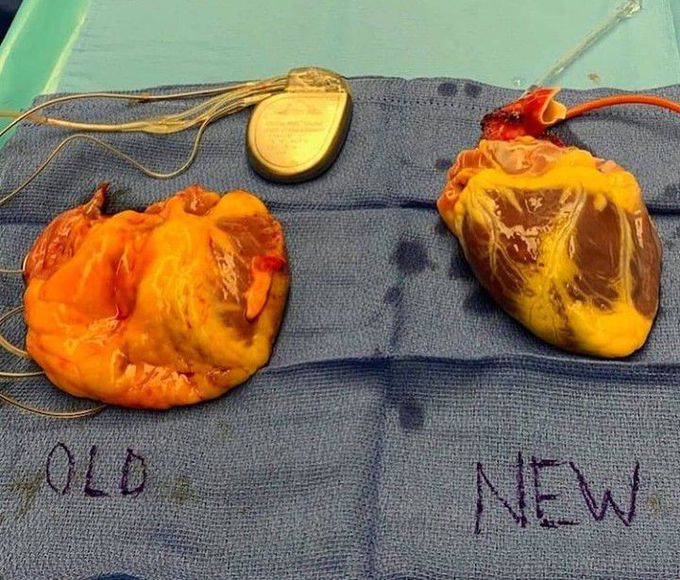 Heart Transplant!