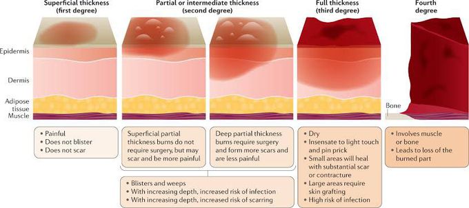 Burn classification