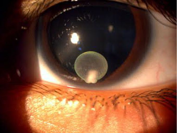Cysticercosis Spreads From Brain To The Eyes
