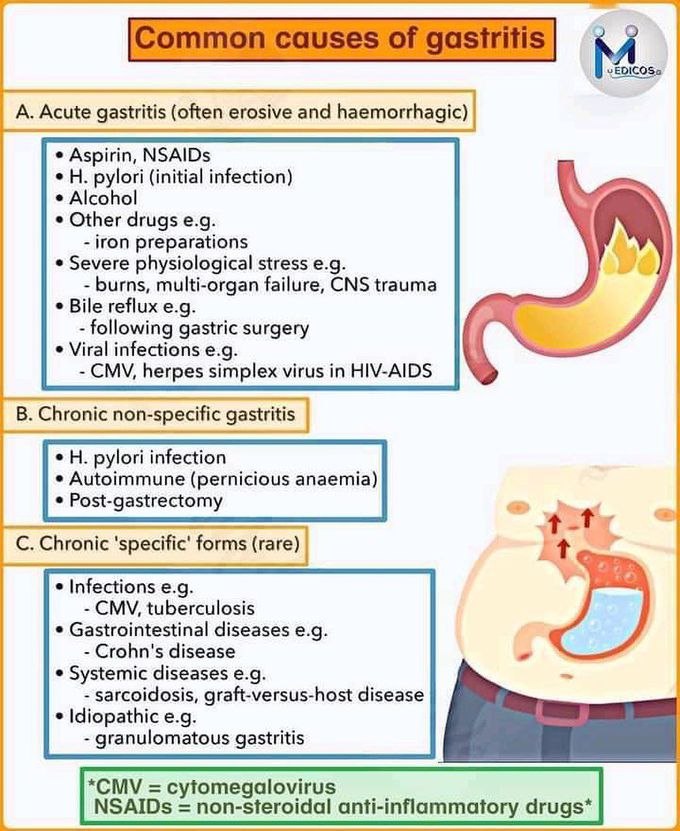 Common causes of gastritis