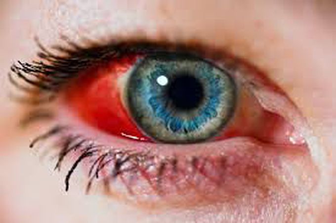 Subconjunctival hemorrhage