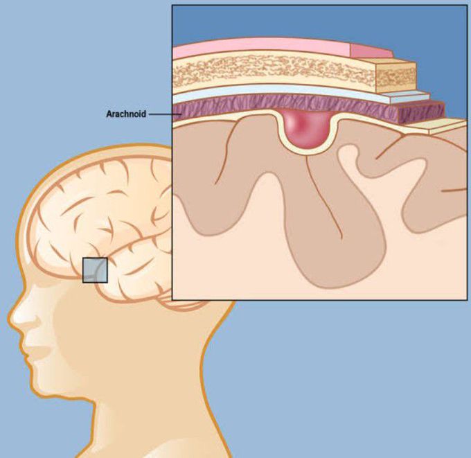 Arachnoid cysts