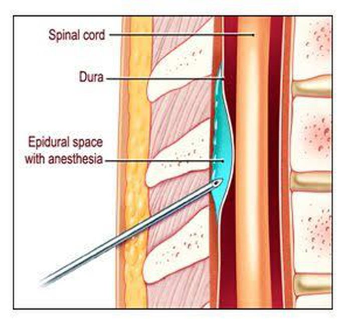 Epidural Anaesthesia