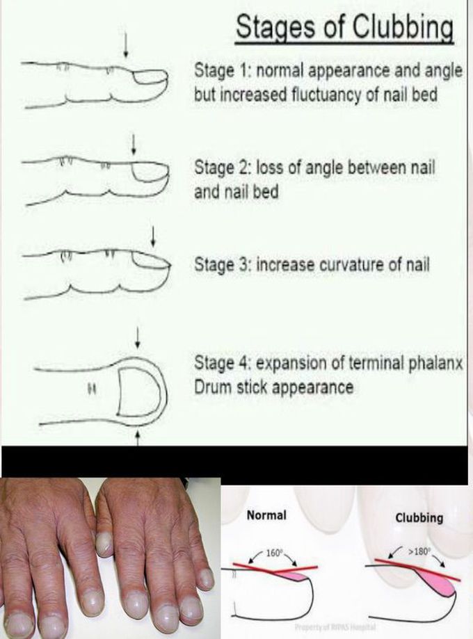 Stages of Clubbing