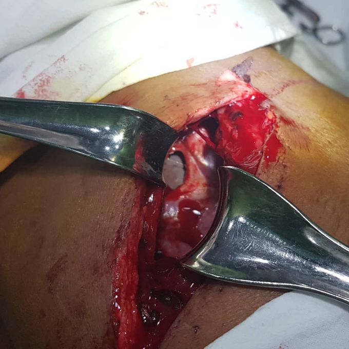 Thoraco-abdominal view in trauma case