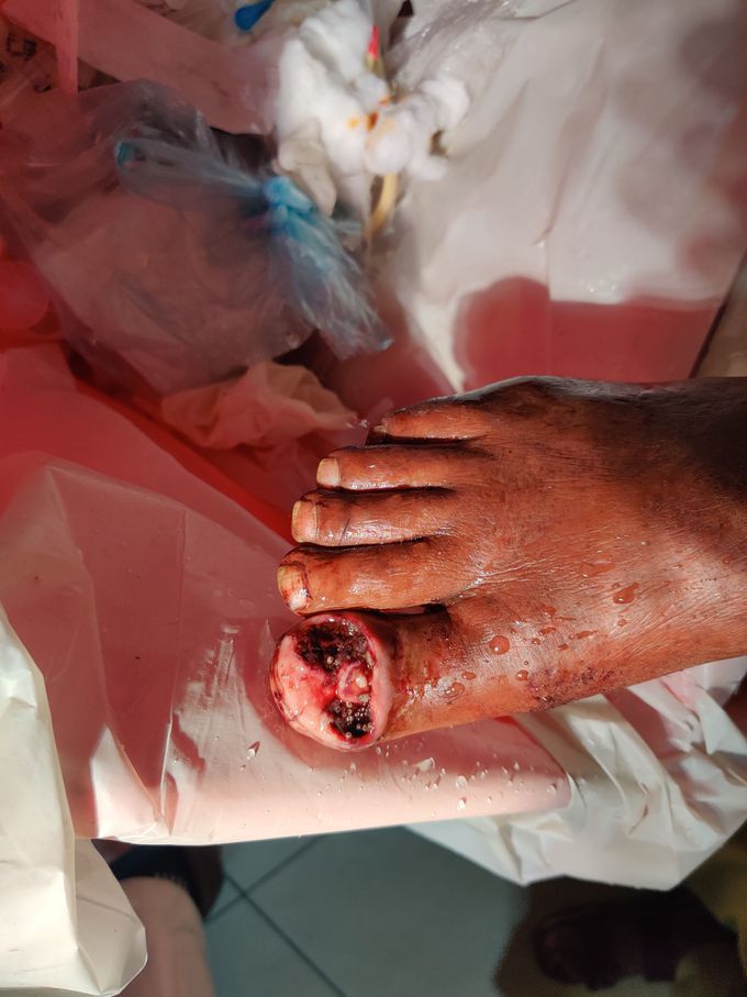 Chronic Infection of foot