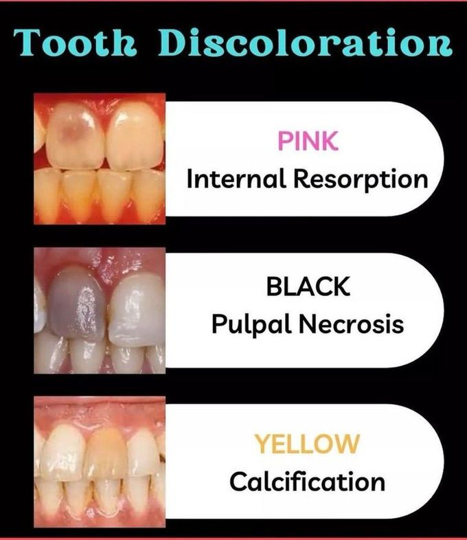 Tooth Discolouration
