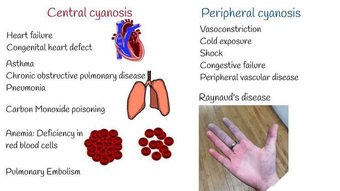 Central Vs Peripheral Cyanosis II