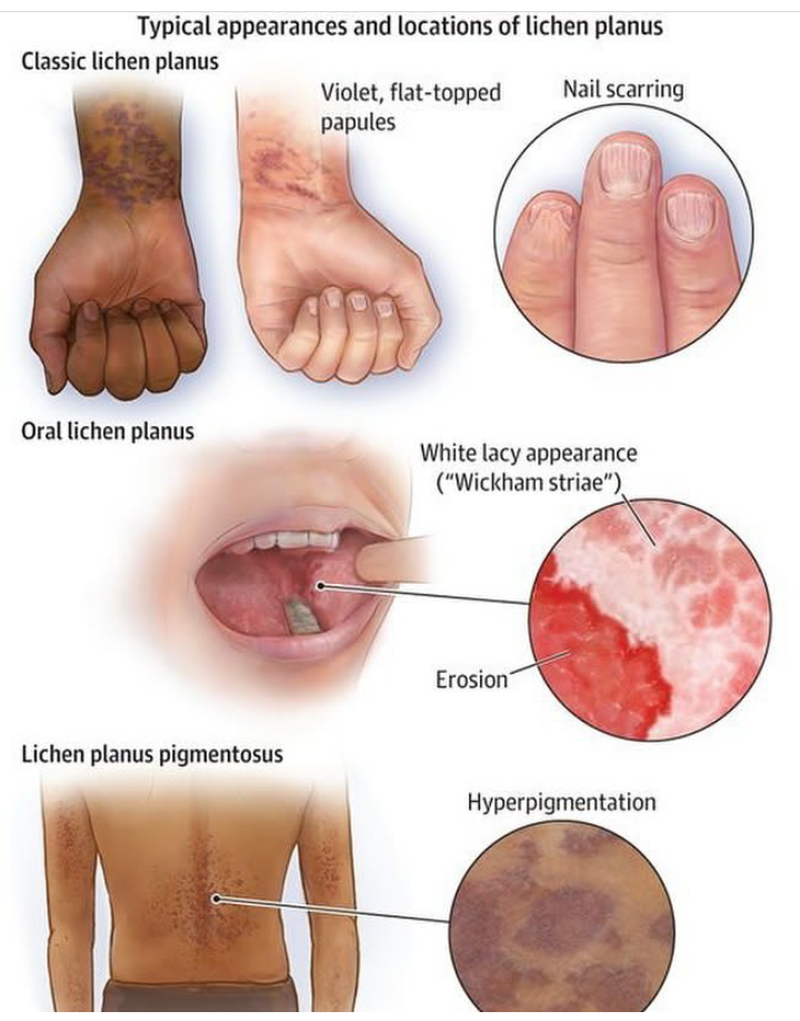 Typical appearance of litchen plants - MEDizzy