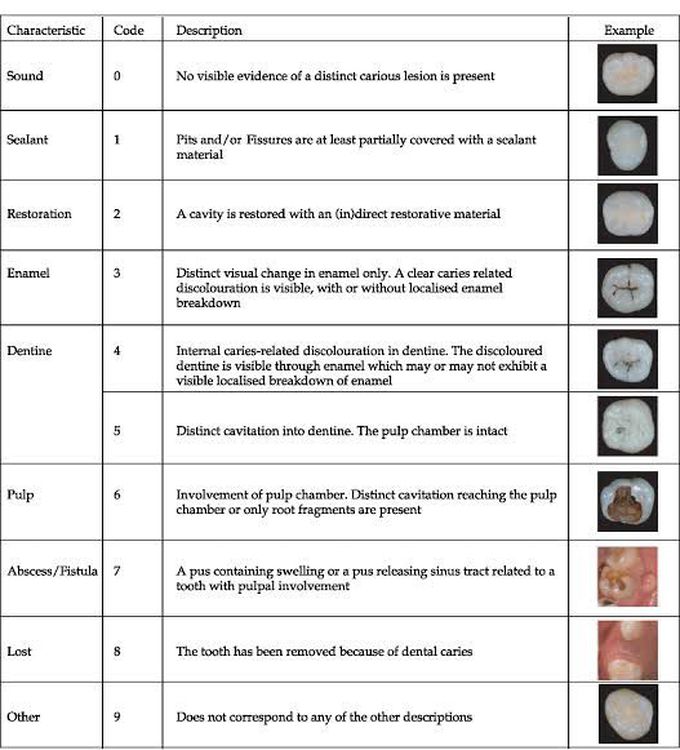 Stages of Dental Caries