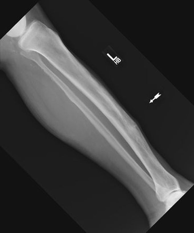 Banana Fracture in Paget's Disease