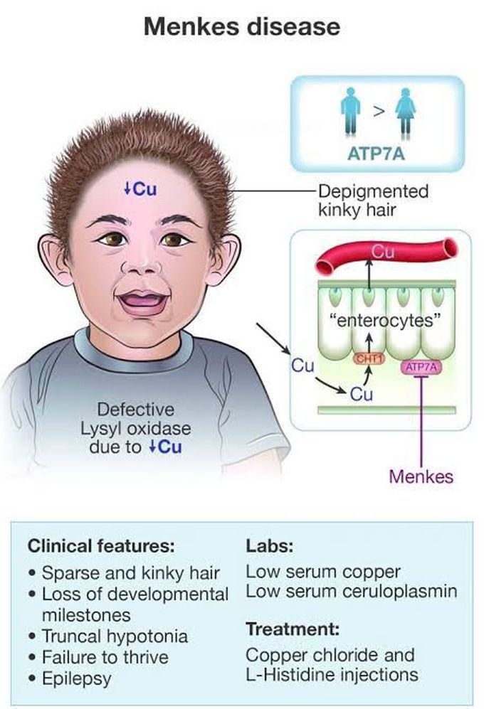 Menkes disease