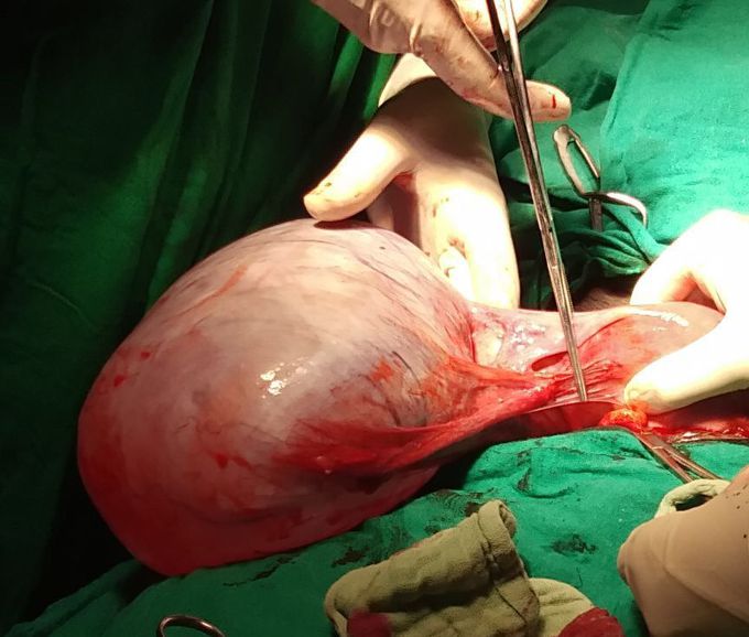 Ovarian cyst
