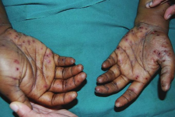 Janeway lesions
