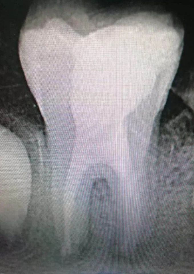 Taurodontism