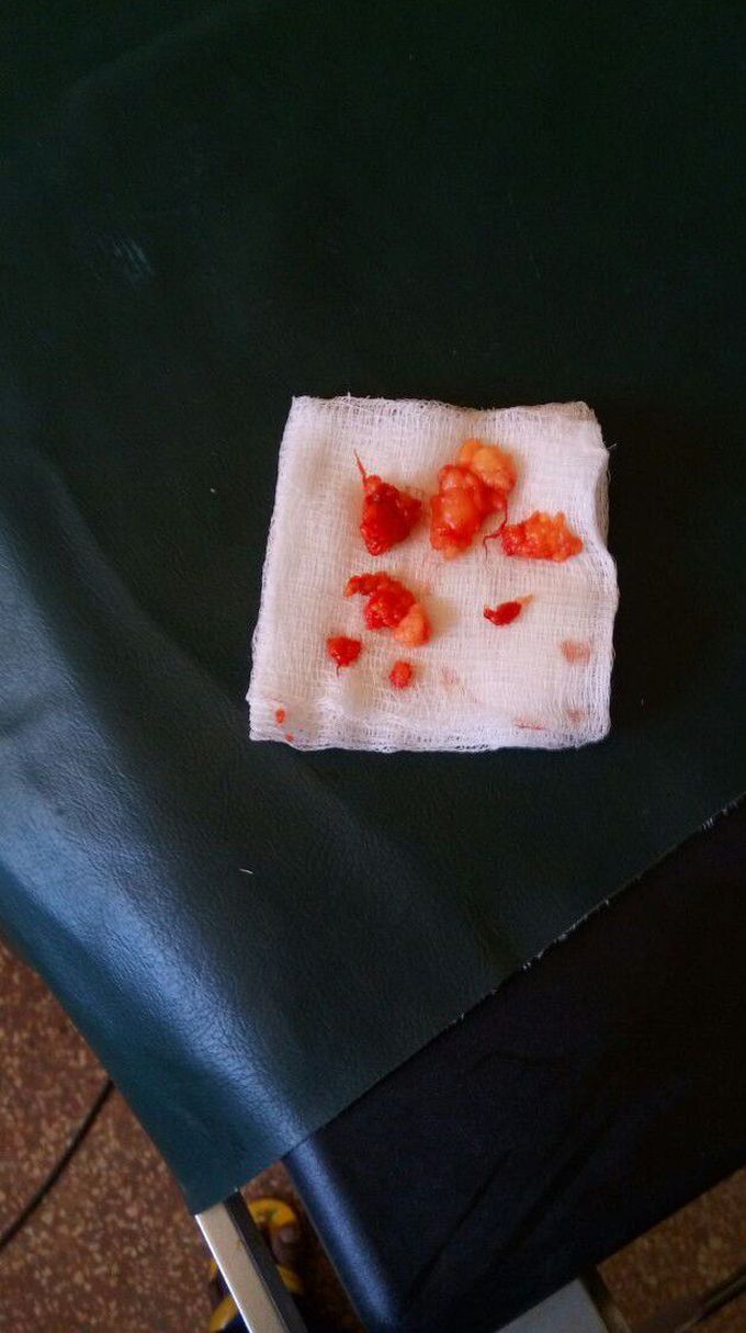 Tissue extraction