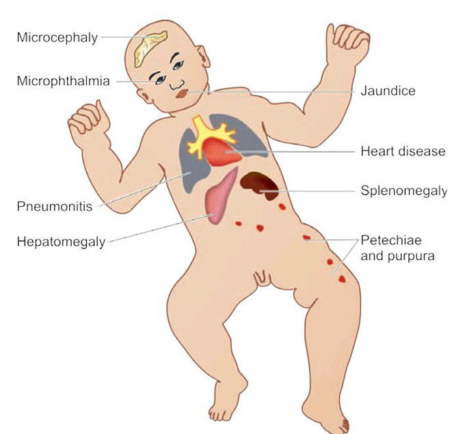 TORCH complex infection