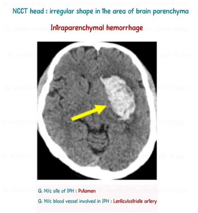 Intraparenchymal Hemorrhage