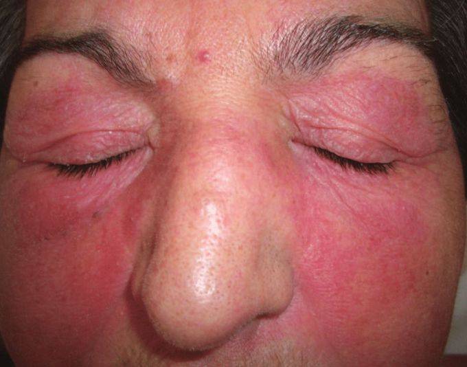 Heliotrope rash-Dermatomyositis