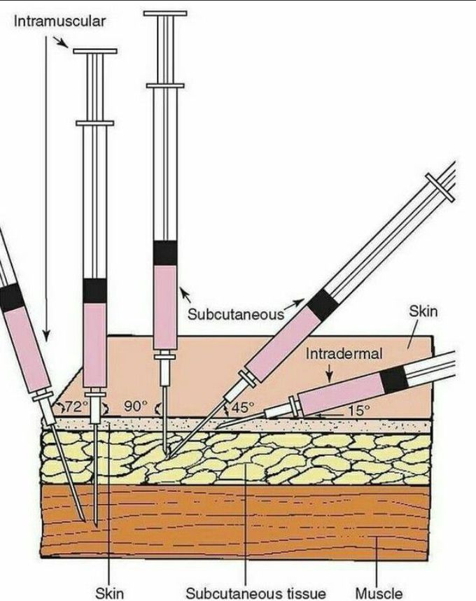 Types of injection