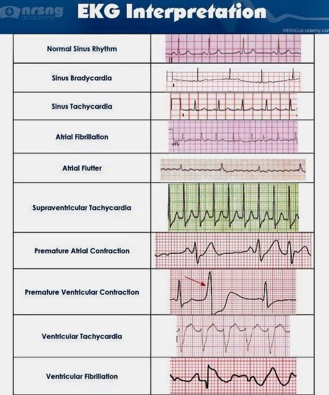 ekg-interpretation-medizzy