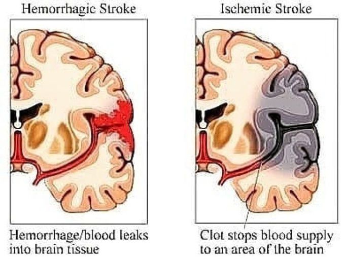 Different types of strokes