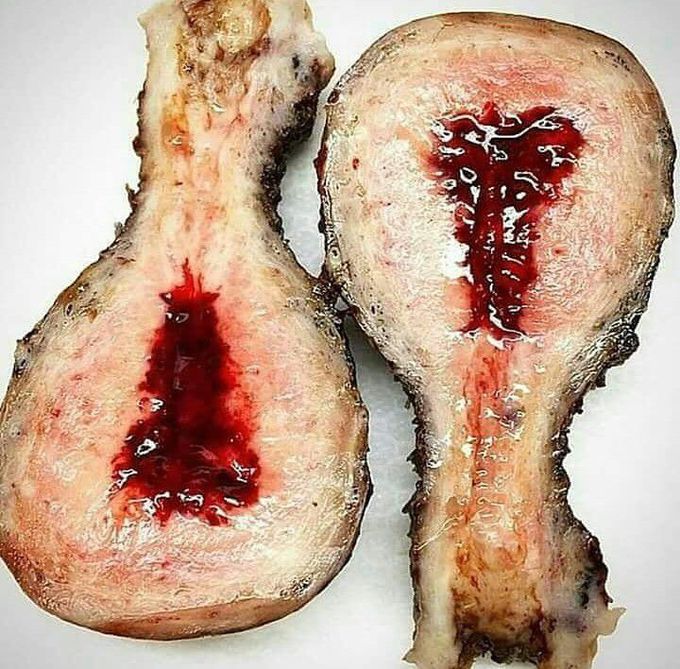 A menstrating Uterus