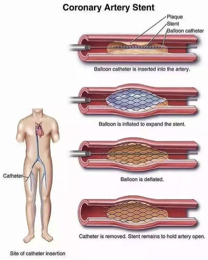 Coronary Artery Stent