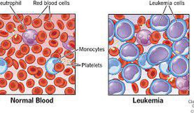 Leukemia - MEDizzy