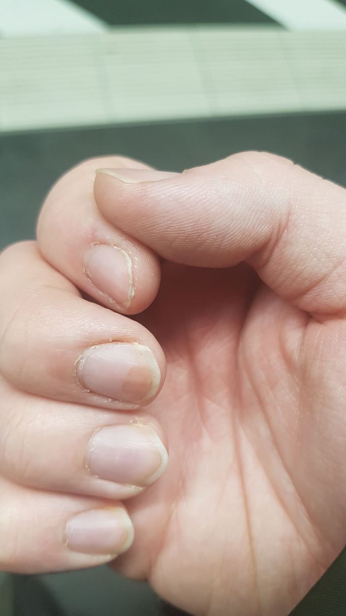 my middlefingers nail has a area which is coloured diffrent. Can anyone tell me why it happened and what it actually does mean?