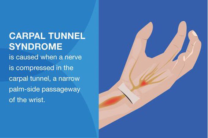 CTS (median nerve affected)