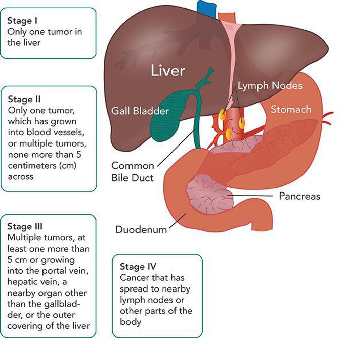 Liver cancer stages