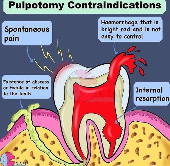 Contraindications of pulpotomy