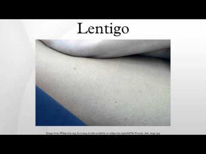 Pigmentation pathology (Lentigo)