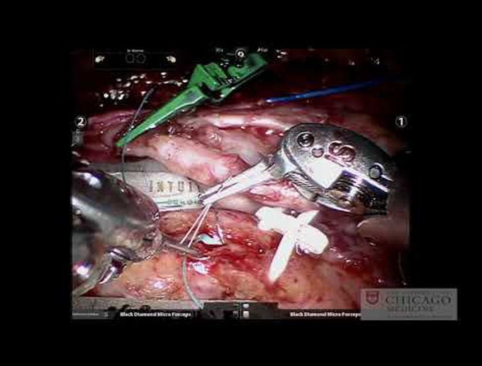 Anastomotic Techniques for Robotic Beating-Heart Totally Endoscopic Coronary Artery Bypass (TECAB)
