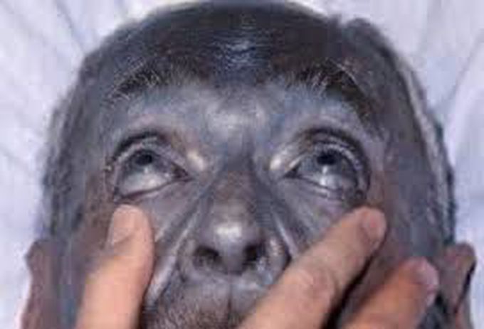 Argyria