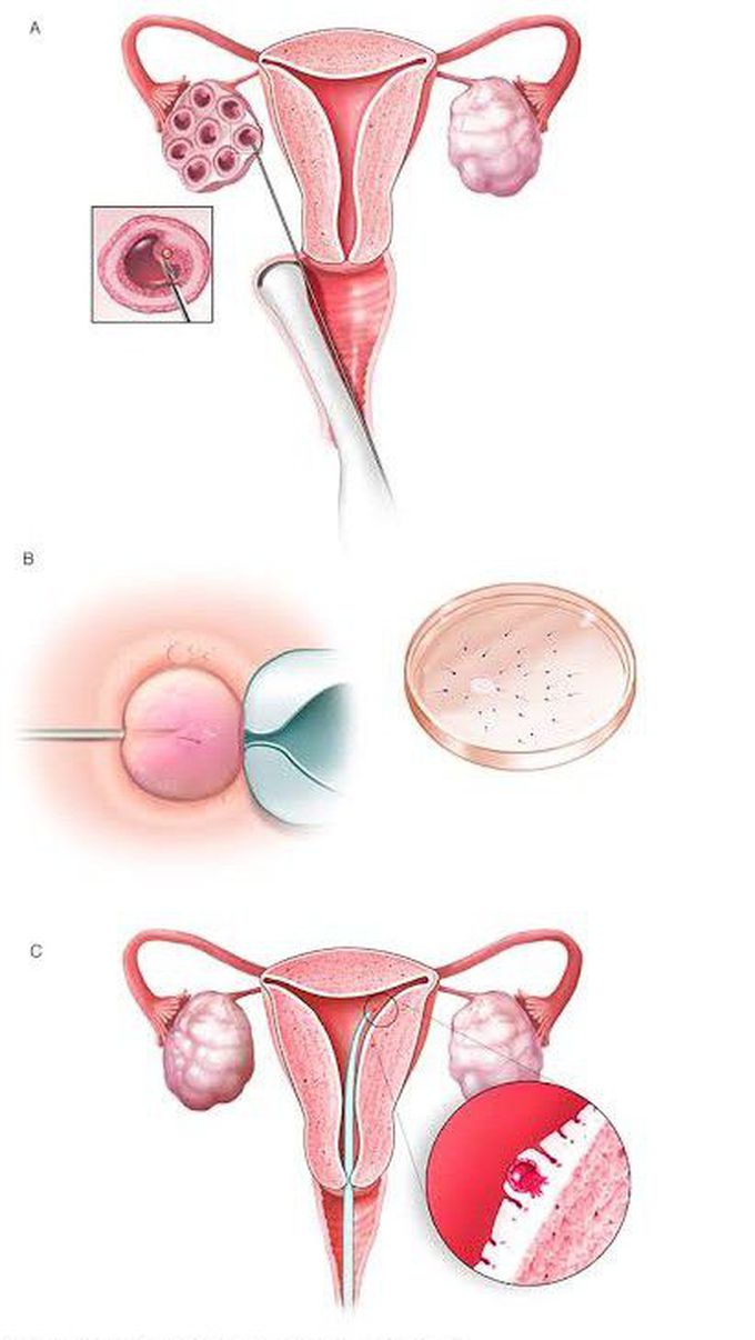 In Vitro Fertilization (IVF)