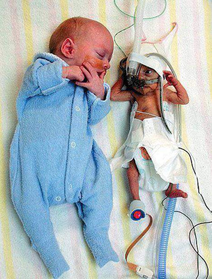 Twin-to-twin transfusion syndrome (TTTS).