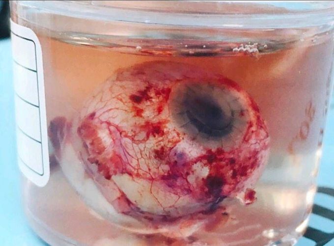 67-year-old male with prior scleral buckle and multiple cornea transplants