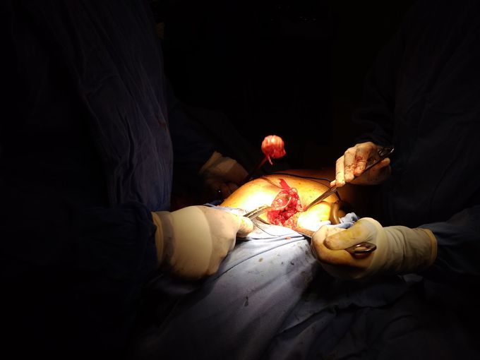 Femoral head