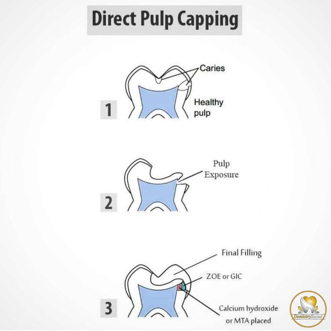 Direct pulp capping
